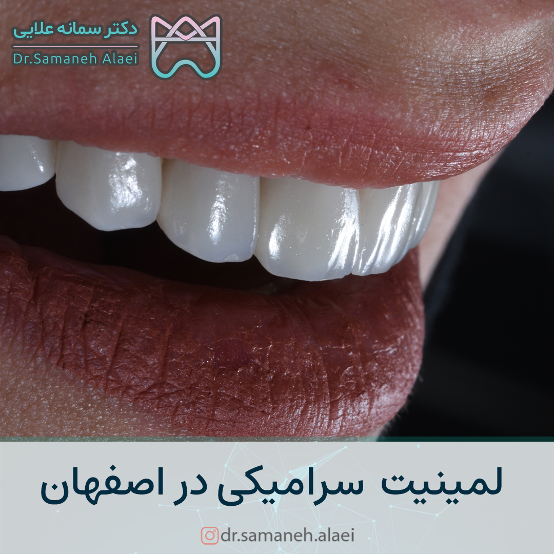 لمینیت سرامیکی در اصفهان | دکتر سمانه علایی متخصص دندانپزشکی زیبایی