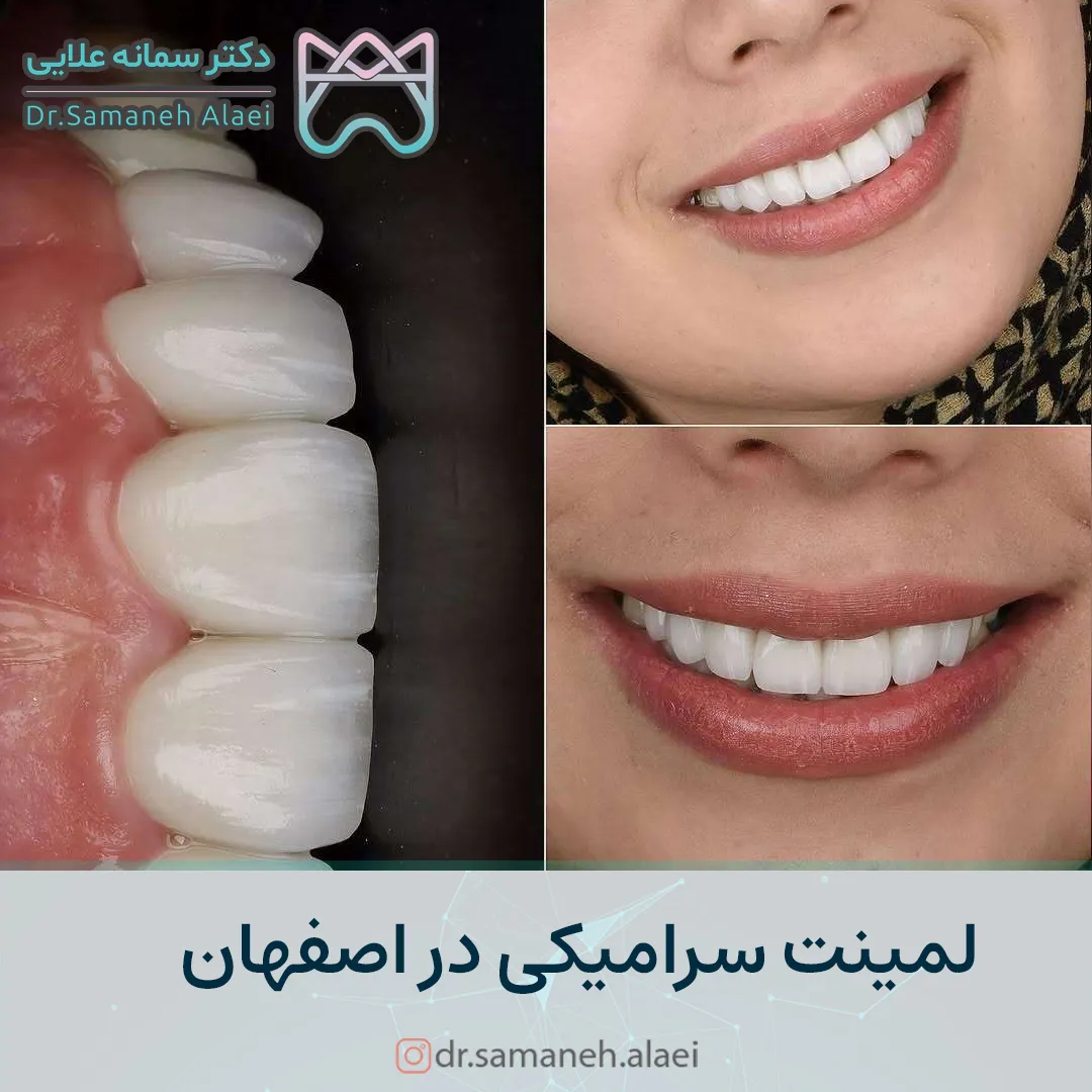 لمینیت سرامیکی در اصفهان | دکتر سمانه علایی متخصص دندانپزشکی زیبایی