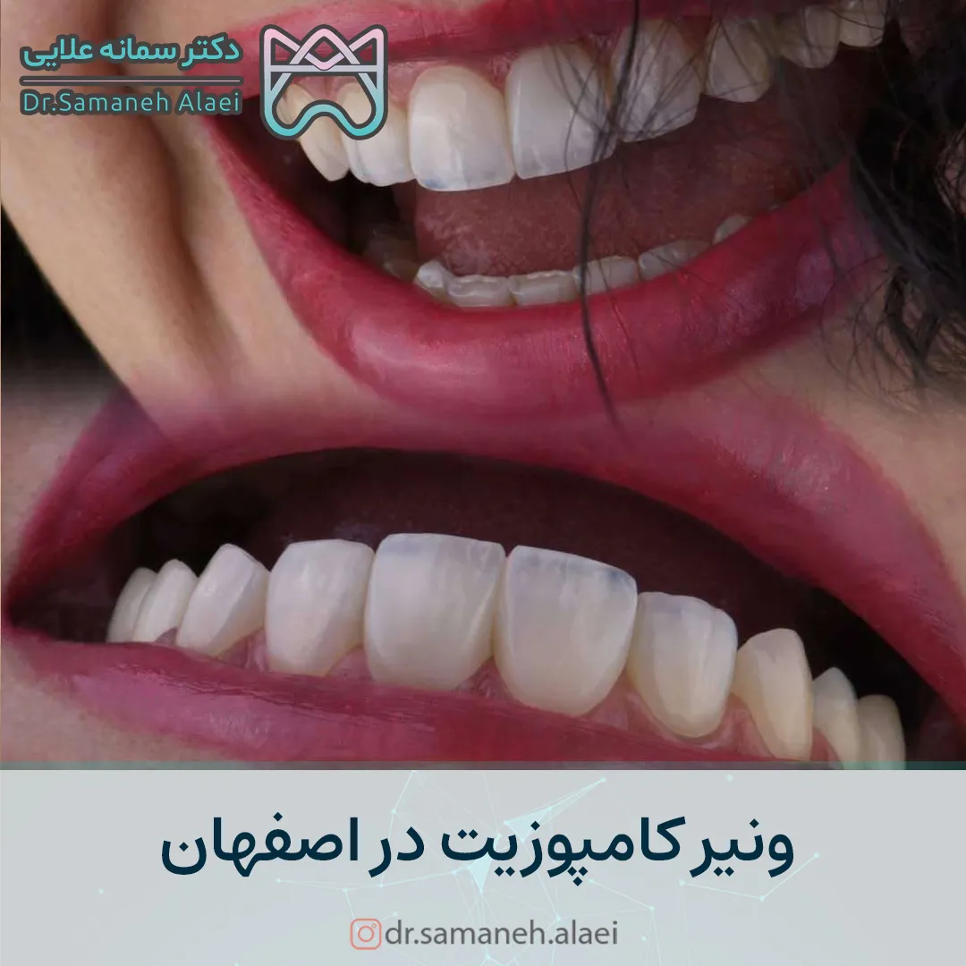 ونیر کامپوزیت در اصفهان دکتر سمانه علایی متخصص دندانپزشکی ترمیمی زیبایی اصفهان