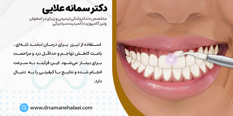 درمان اصلاح لبخند لثه ای با لیزر در اصفهان