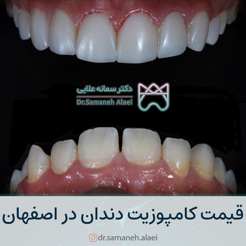 قیمت کامپوزیت دندان در اصفهان