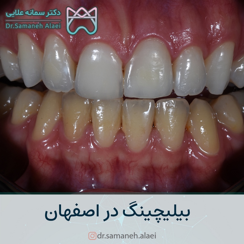 بلیچینگ دندان در اصفهان
