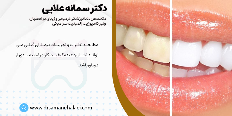 مطالعه نظرات بیماران قبلی نشان دهنده کیفیت درمان دندانپرشک بلیچینگ در اصفهان است
