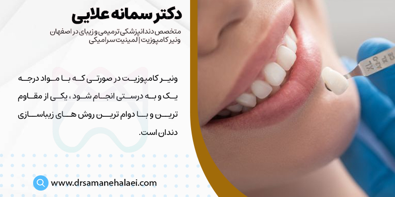 مقاومت بالای ونیر کامپوزیت دندان