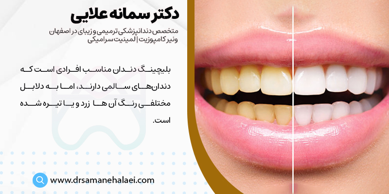 بلیچینگ دندان مناسب افرادی است که دندان‌های سالمی دارند