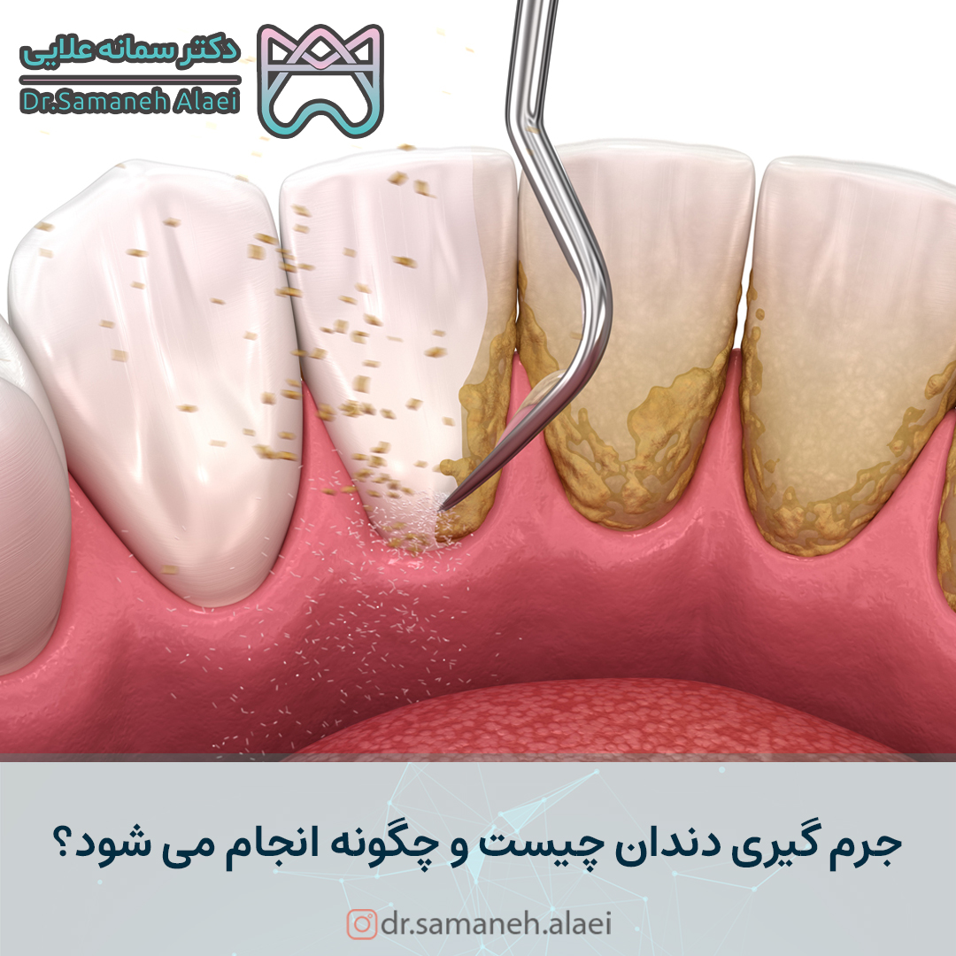 جرم گیری دندان چیست و چگونه انجام می شود؟