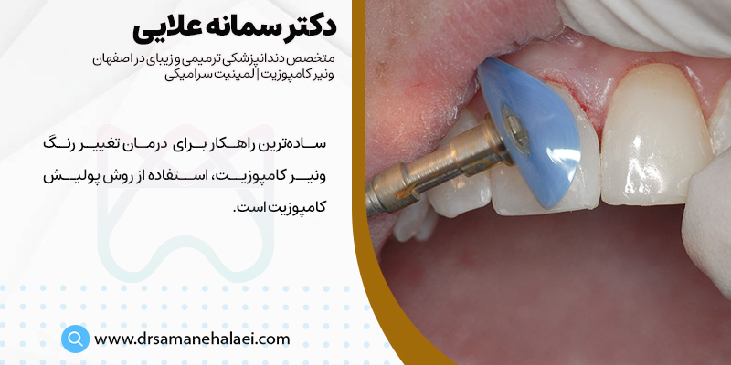 پولیش کامپوزیت جهت درمان تغییر رنگ کامپوزیت دندان