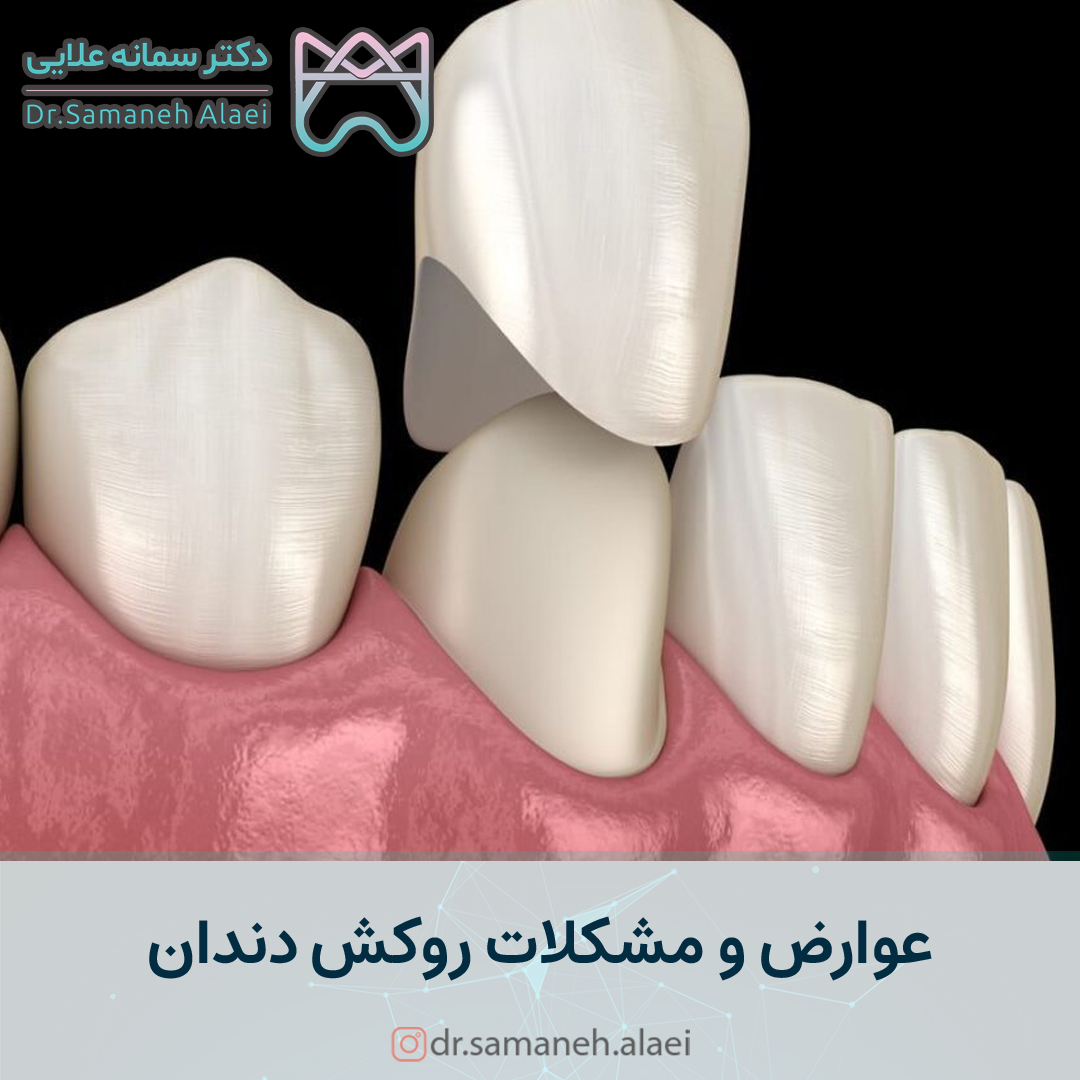 عوارض و مشکلات روکش دندان
