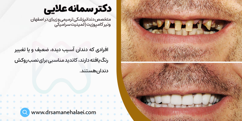 تاج دندان برای افرادی که دندان های آسیب دیده دارند مناسب است
