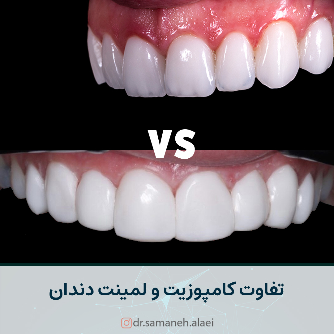 تفاوت كامپوزيت و لمينت دندان