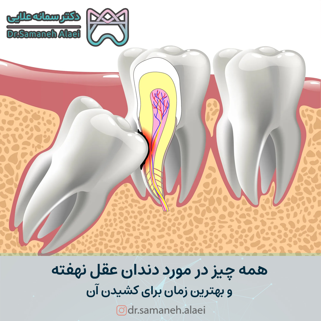 دندان عقل نهفته و بهترین زمان برای کشیدن آن