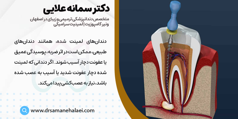 عصب کشی دندان لمینت شده