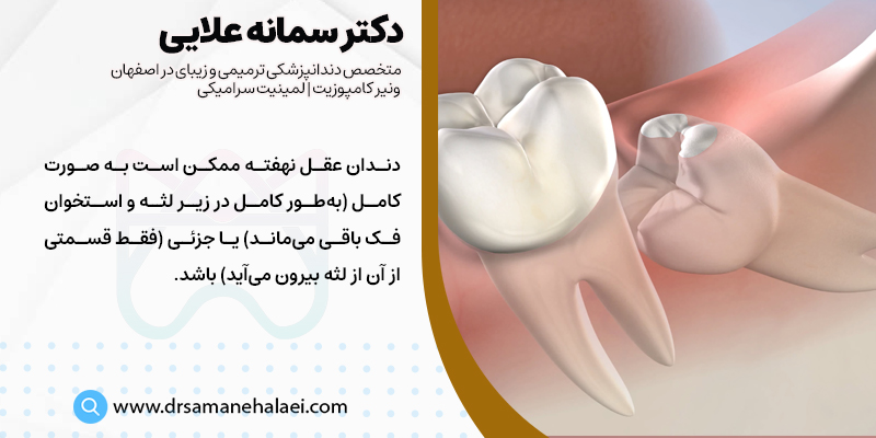 دندان عقل نهفته چیست