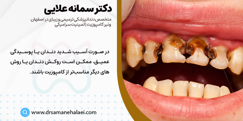 کامپوزیت کردن دندان ها برای دندان های با پوسیدگی شدید مناسب نیست