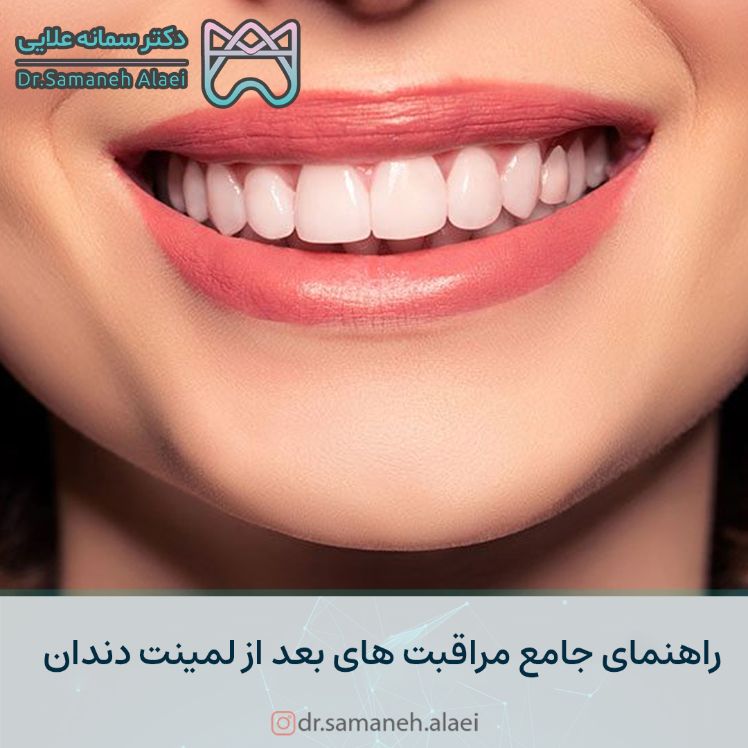 مراقبت های بعد از لمینت دندان