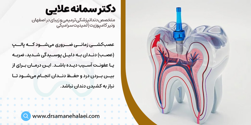 چه زمانی باید عصل کشی دندان انجاد داد؟