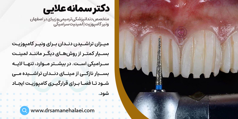 میزان تراش دندان برای کامپوزیت کردن دندان