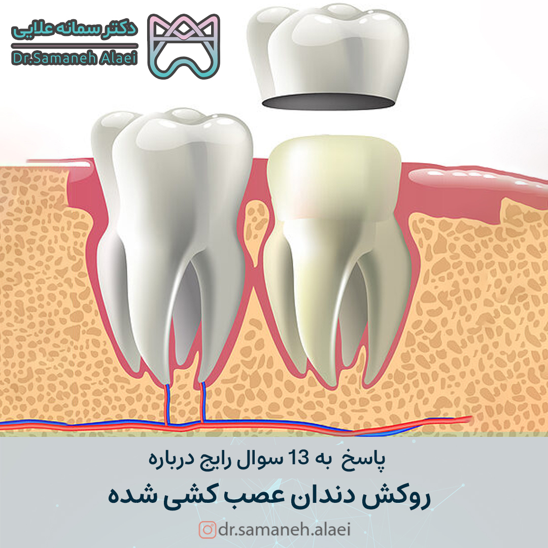 پاسخ به 13سوال رایج درباره روکش دندان عصب کشی شده