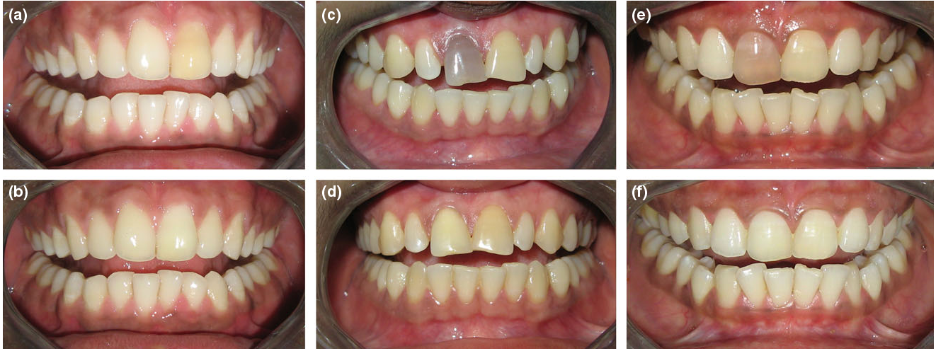 نمونه های درمانی بلیچینگ داخلی دندان