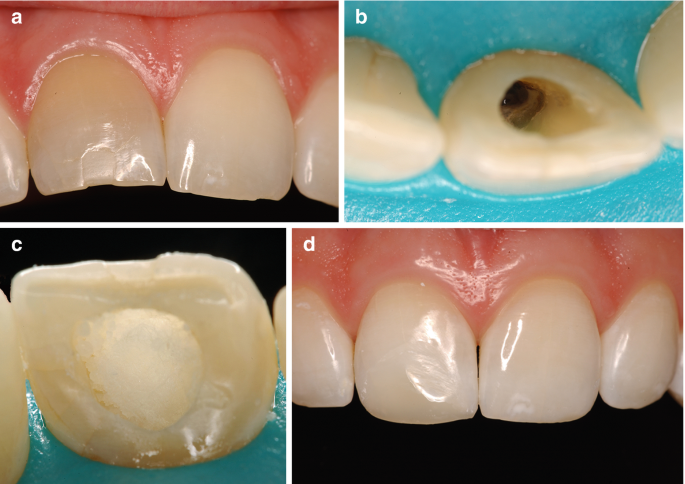 مراحل سفید کردن داخل دندان | بلیچینگ داخل دندان