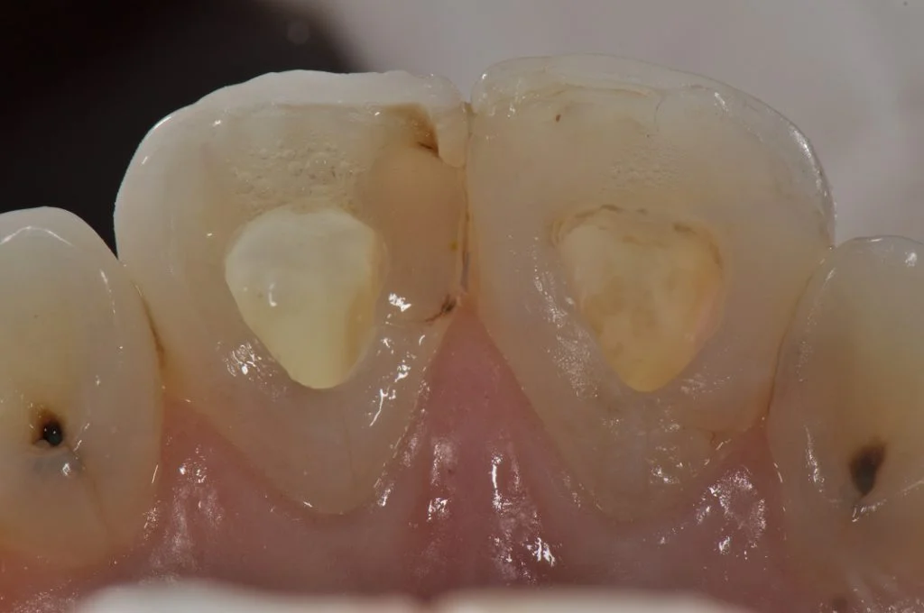 سفید کردن داخل دندان