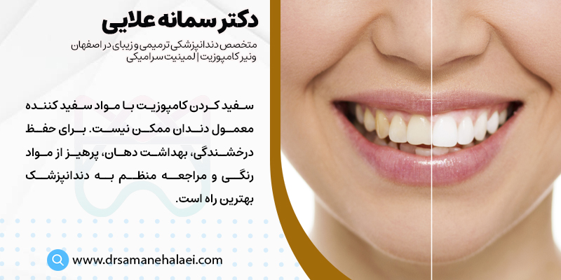 بهترین راه سفید کردن ونیر کامپوزیت دندان