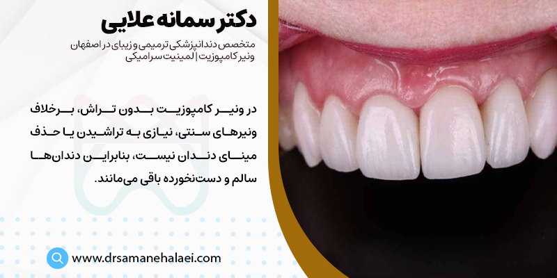 کامپوزیت دندان بدون تراش