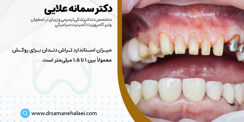 میزان تراش دندان برای روکش