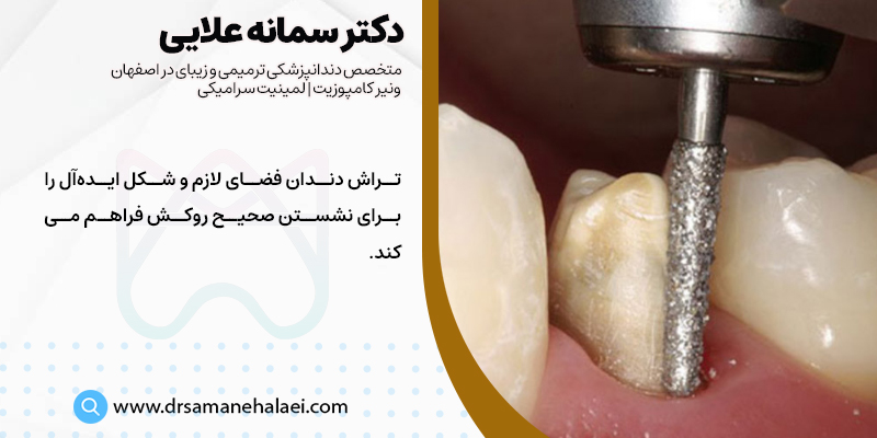 علت تراش دندان برای روکش