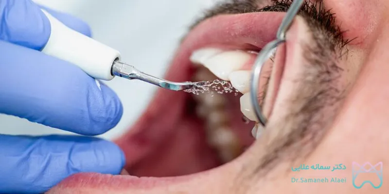 جرمگیری دندان در اصفهان