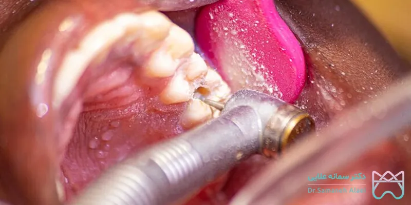 جرمگیری دندان در اصفهان