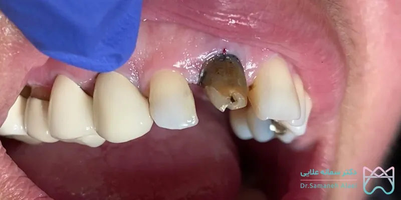 عکس پوسیدگی زیر روکش دندان