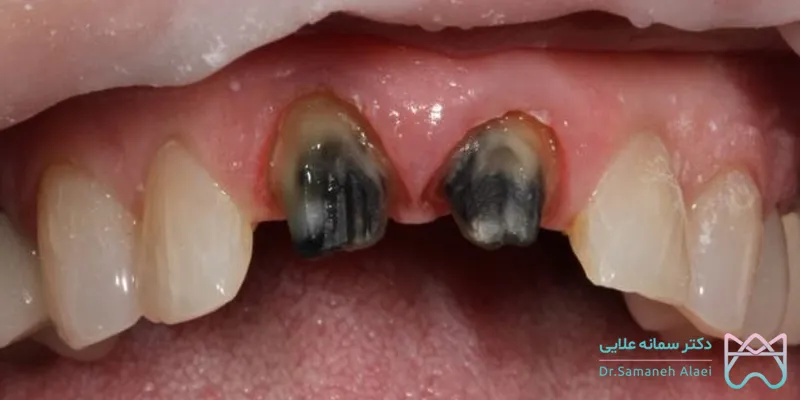 پوسیدگی زیر روکش دندان