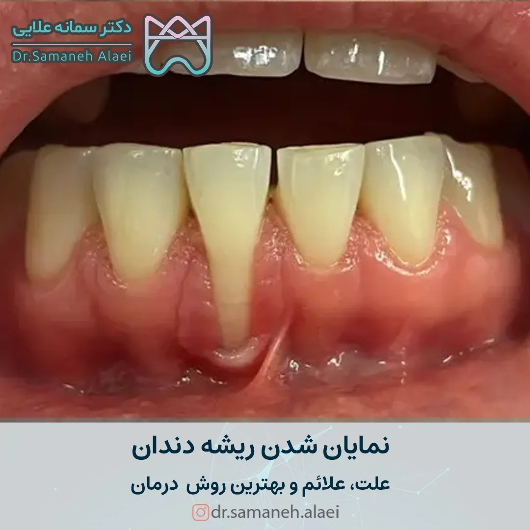 دندانی که ریشه‌اش بیرون زده چطور درمان می‌شود؟