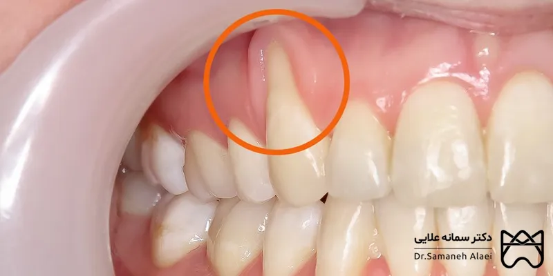 نمایان شدن ریشه دندان