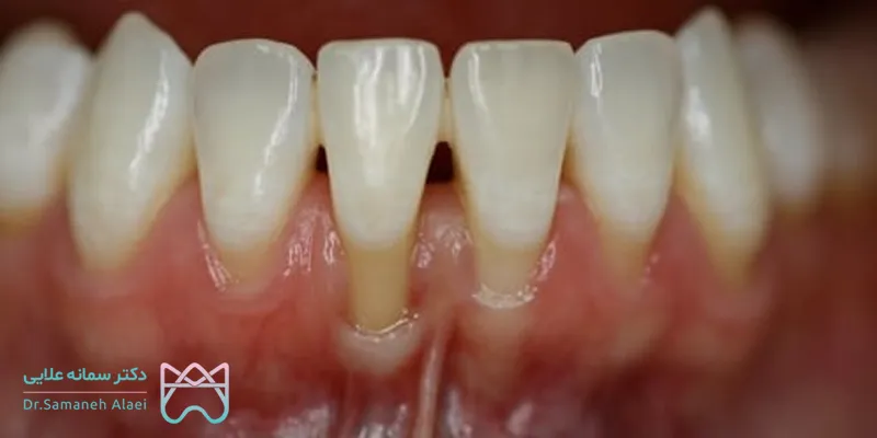 اکسپوز شدن ریشه 