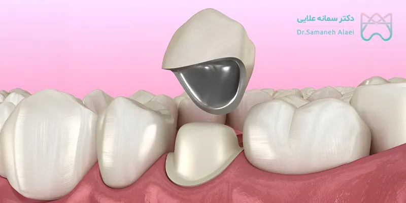 روکش PFM چیست؟