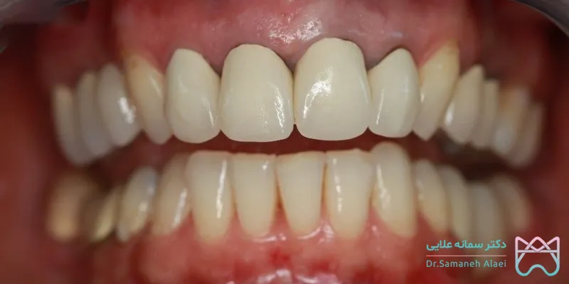 نمونه کار روکش PFM