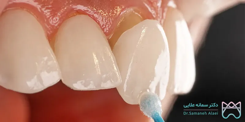 ونیر کامپوزیت سوئیسی