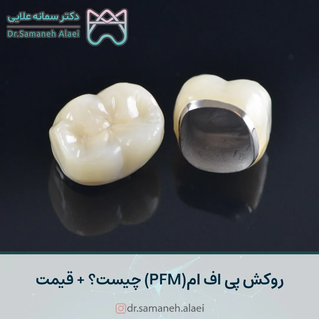 روکش پی اف ام(PFM) چیست؟ + قیمت