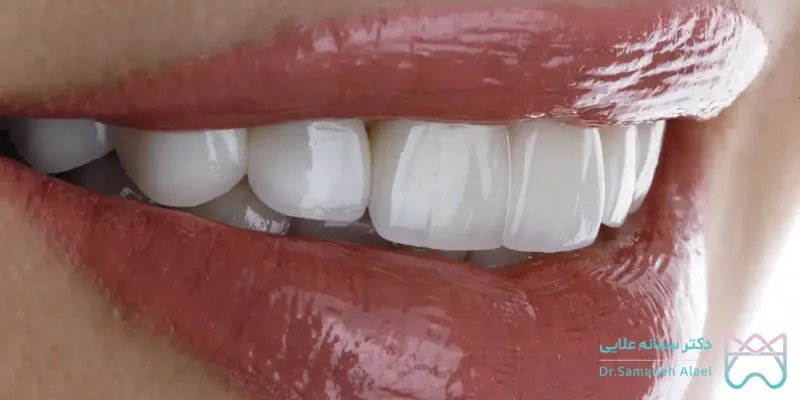 روکش زیکونیوم