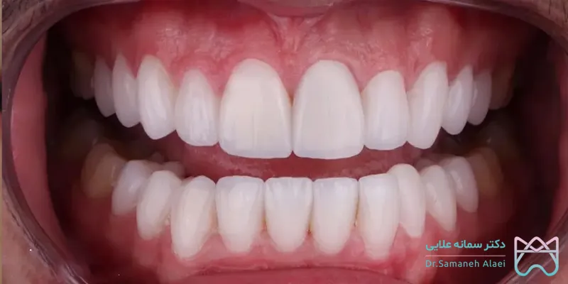 عکس روکش زیرکونیا