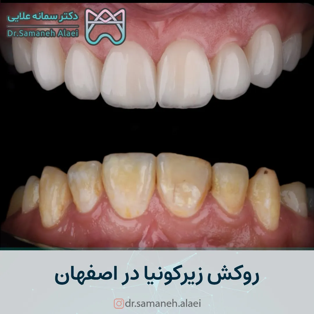 روکش زیرکونیا در اصفهان
