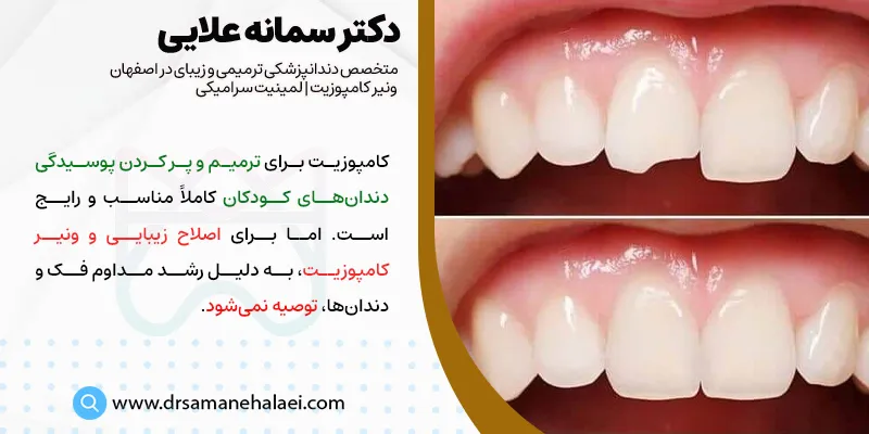 کامپوزیت دندان برای کودکان