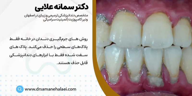 روش جرم گیری دندان در خانه