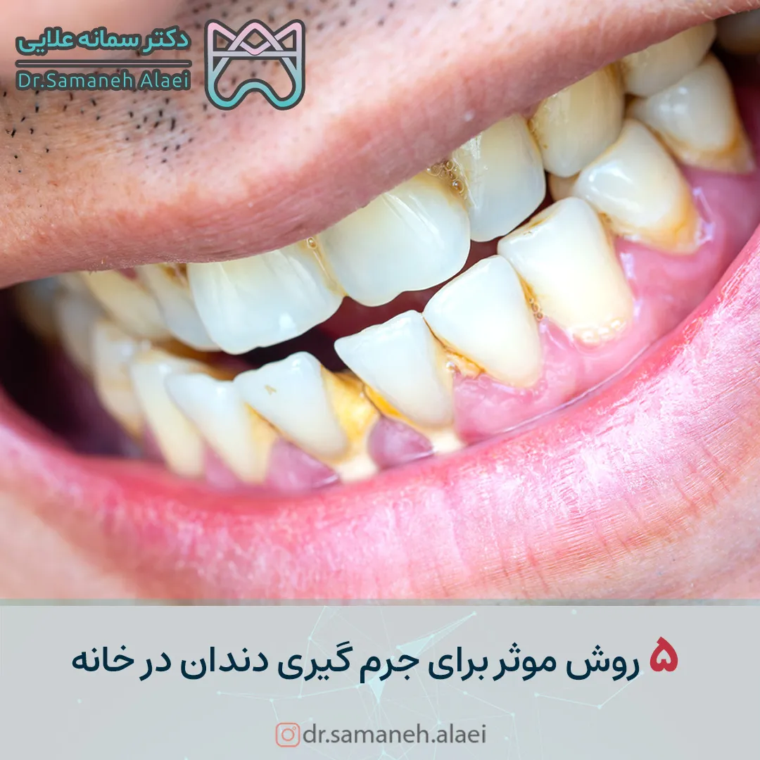 5 روش موثر برای جرم گیری دندان در خانه