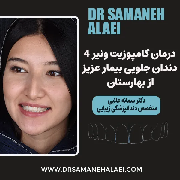درمان ونیر کامپوزیت 4 دندان جلویی بیمار عزیز از بهارستان