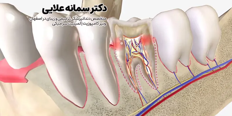 درد دندان عصب کشی و روکش شده