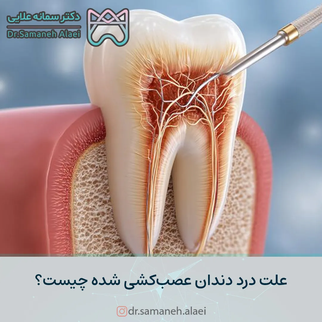 درد دندان عصب کشی شده