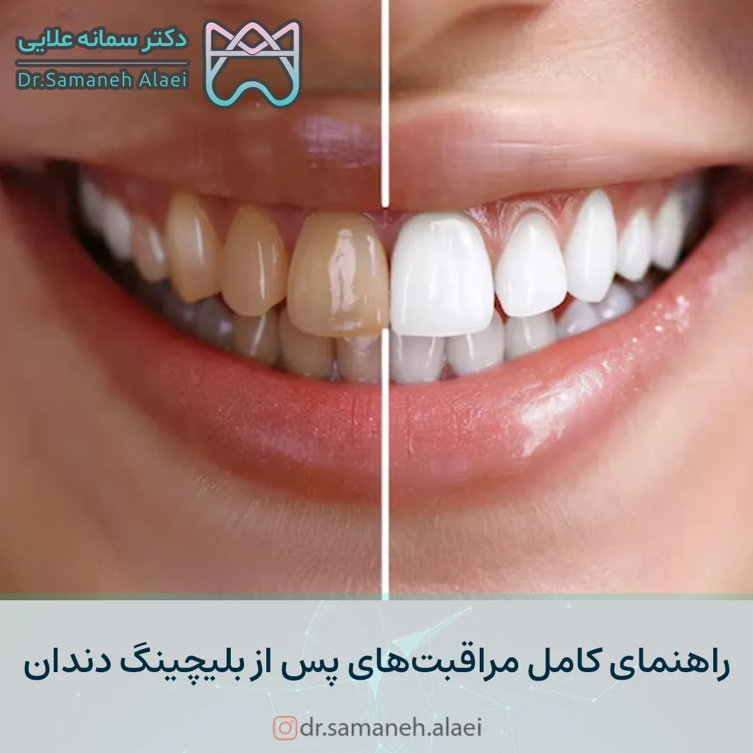 راهنمای کامل مراقبت های بعد از بلیچینگ دندان